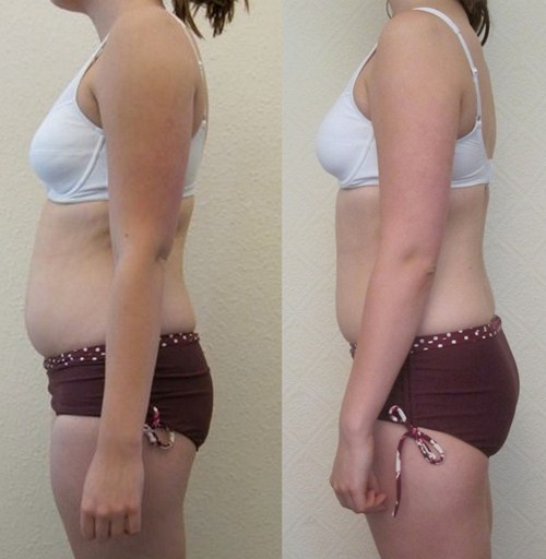 Antes e depois do Pilates. Realmente emagrece Antes e depois do Pilates. Realmente emagrece